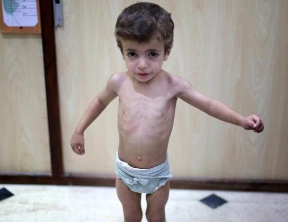 儿童太瘦是什么原因 营养不足 脾胃不和