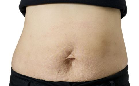 孕期出现的妊娠线到底是什么 什么是妊娠线 出现妊娠线的原因