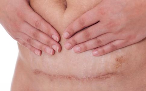 剖腹产的好处 剖腹产的优势 剖腹产有哪些优势