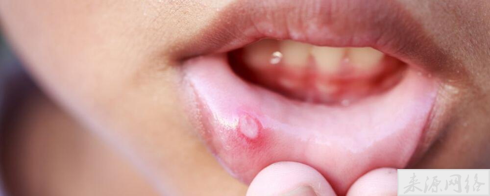 为什么会经常容易上火 上火的表现有哪些 上火吃什么水果比较好