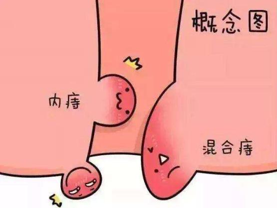 痔疮长什么样子的?痔疮的早期症状,痔疮图片真人图