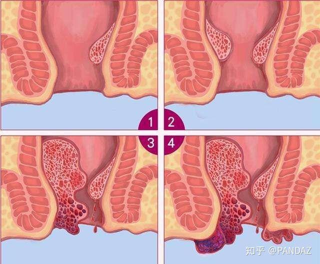 痔疮长什么样子的?痔疮的早期症状,痔疮图片真人图