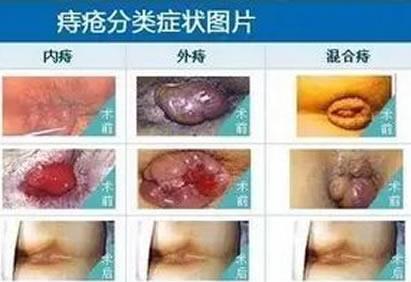 痔疮长什么样子的?痔疮的早期症状,痔疮图片真人图